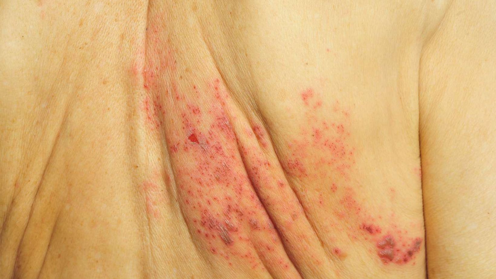 Spike in NSW Google Searches Amid Scabies Outbreak in Hospitals