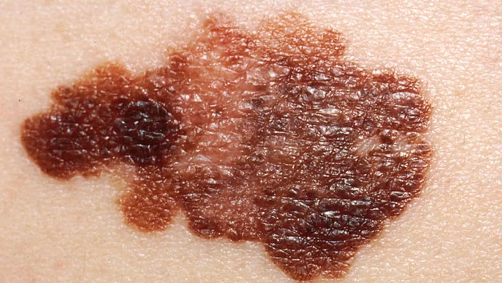Melanoma - True Spring Nutrition Melanoma