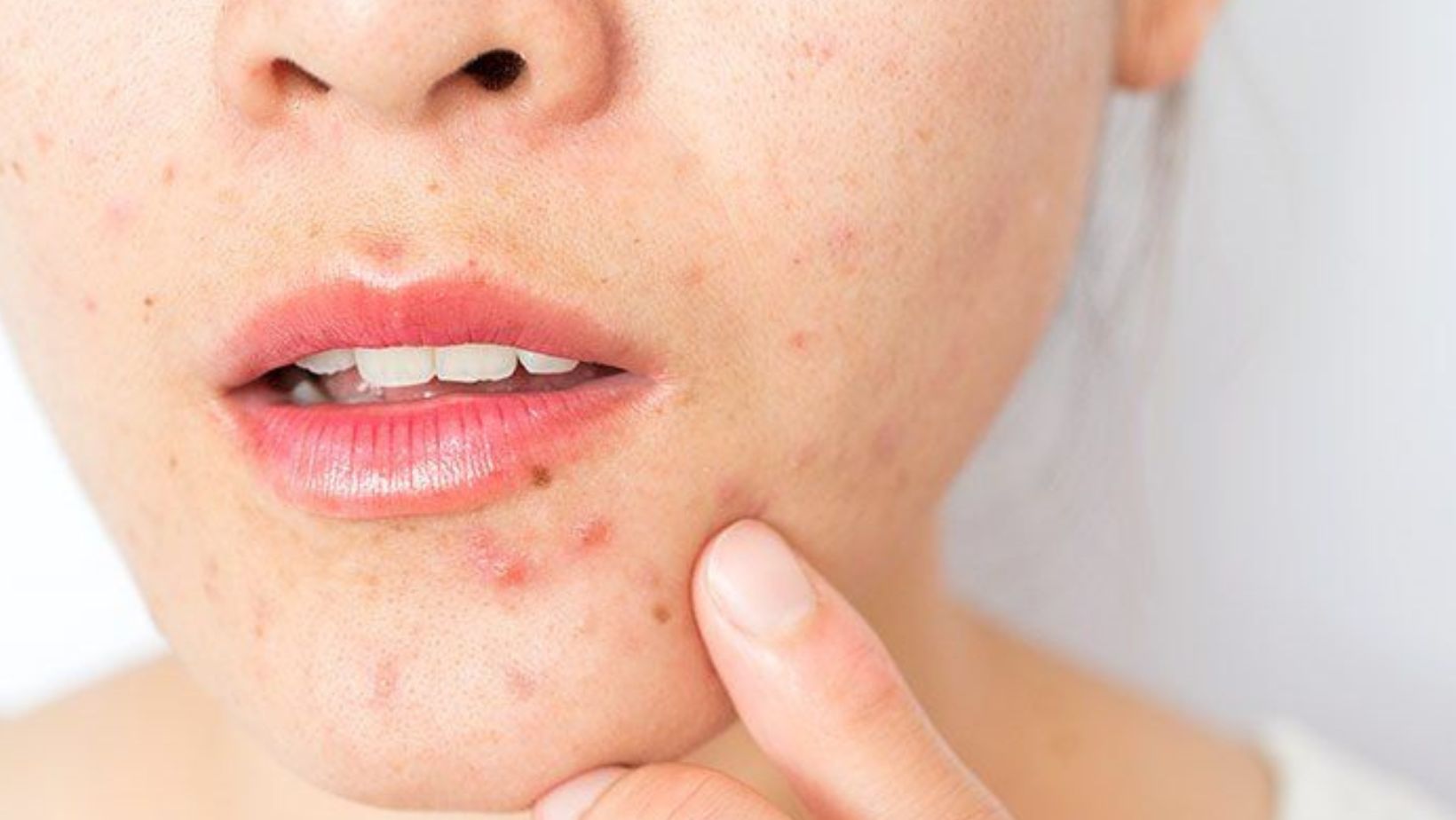 To Squeeze or Not to Squeeze? Why Popping Pimples Does More Harm Than Good