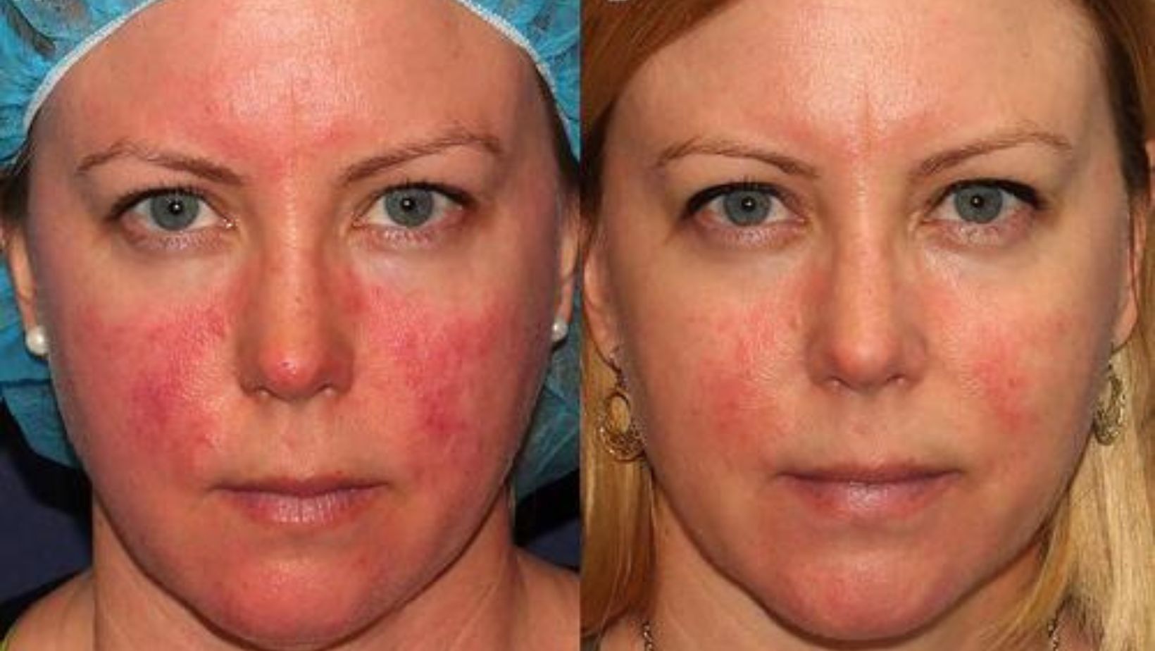 Rosacea Treatment