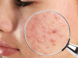 Acne Bacteria