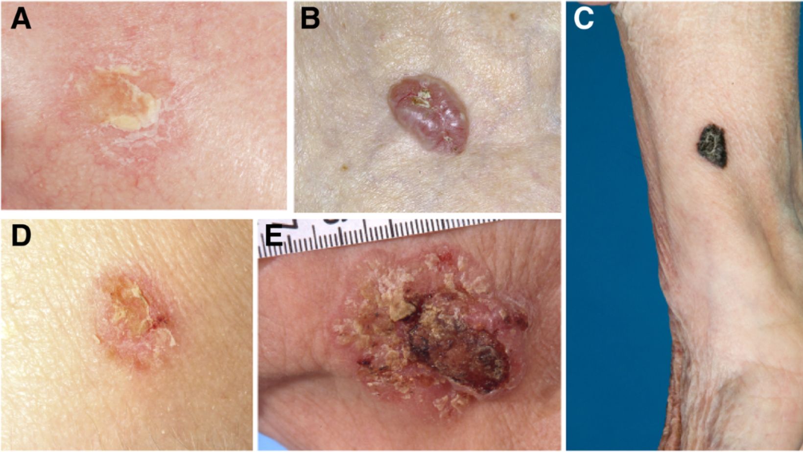 Skin Cancer - True Spring Nutrition Skin Cancer