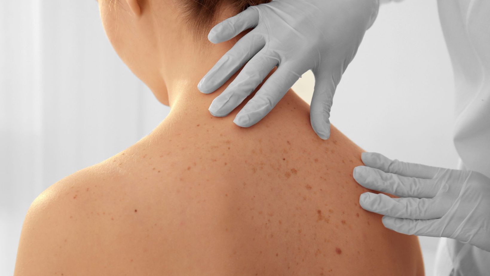 Skin Cancer - True Spring Nutrition Skin Cancer
