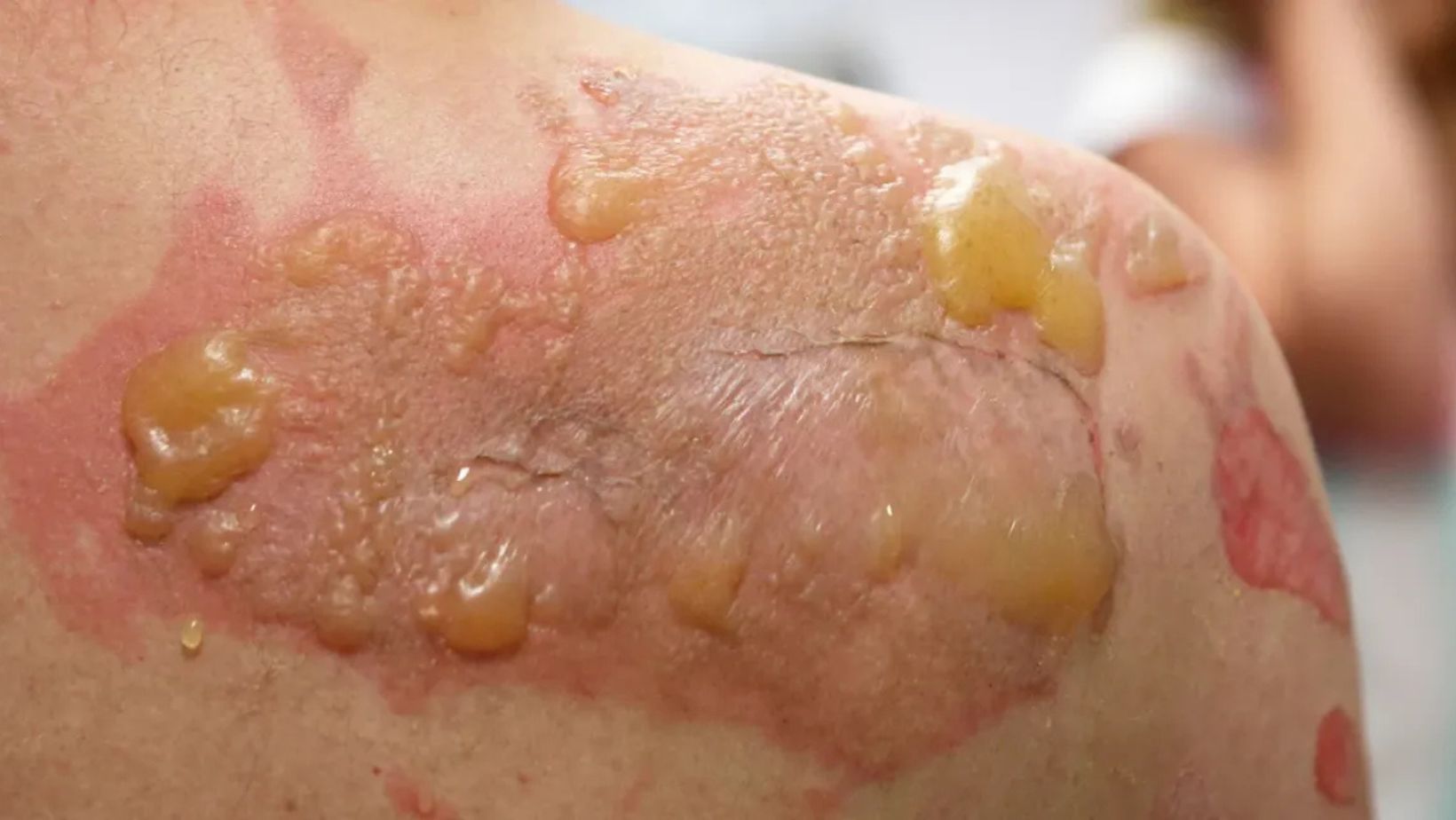 Skin Dangers