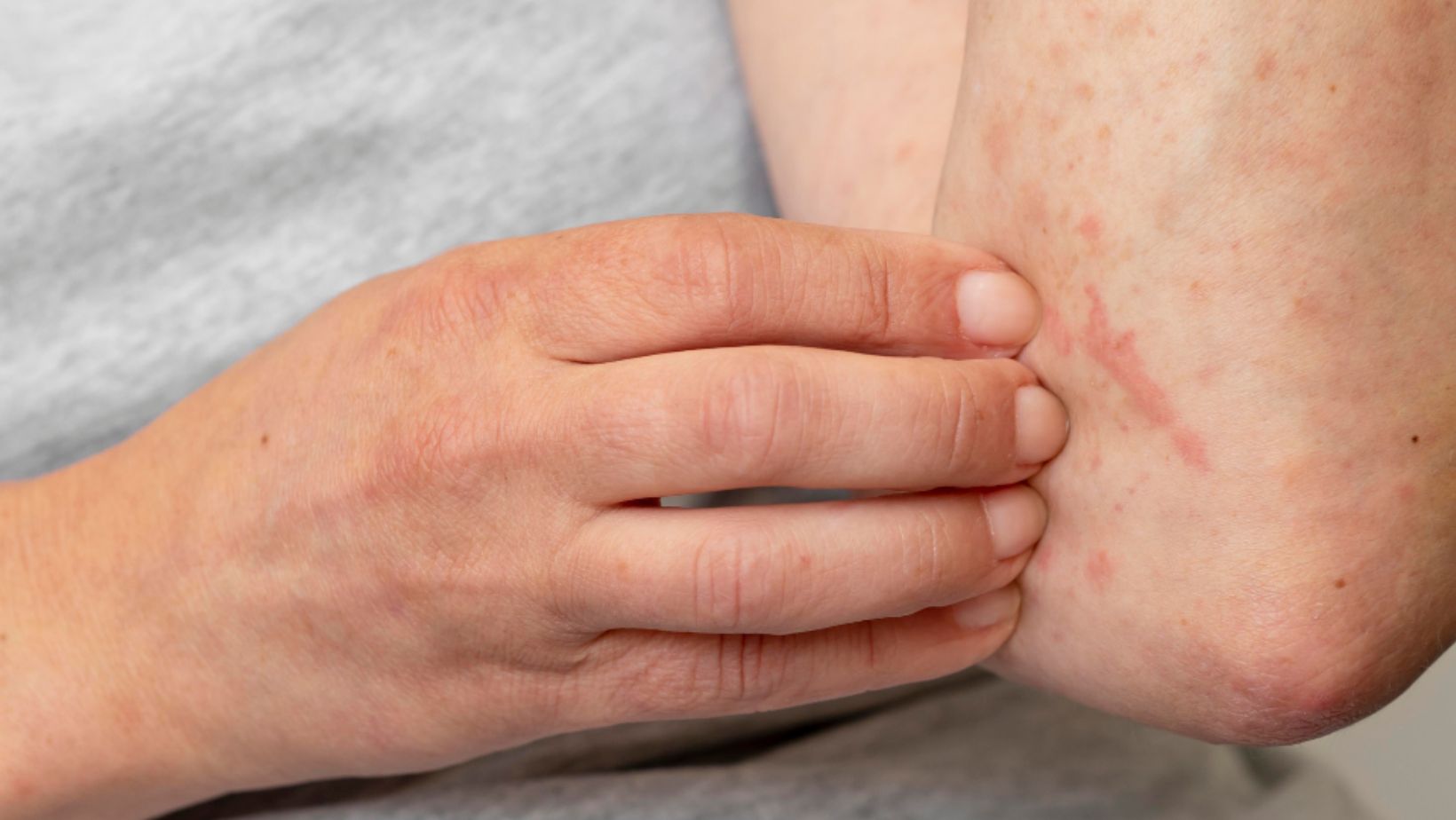 Spike in NSW Google Searches Amid Scabies Outbreak in Hospitals