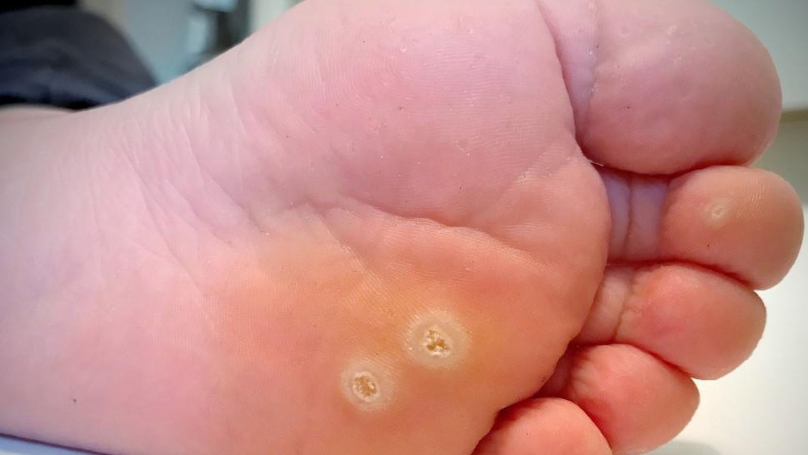 Do Home Remedies for Warts Work? Experts Weigh In