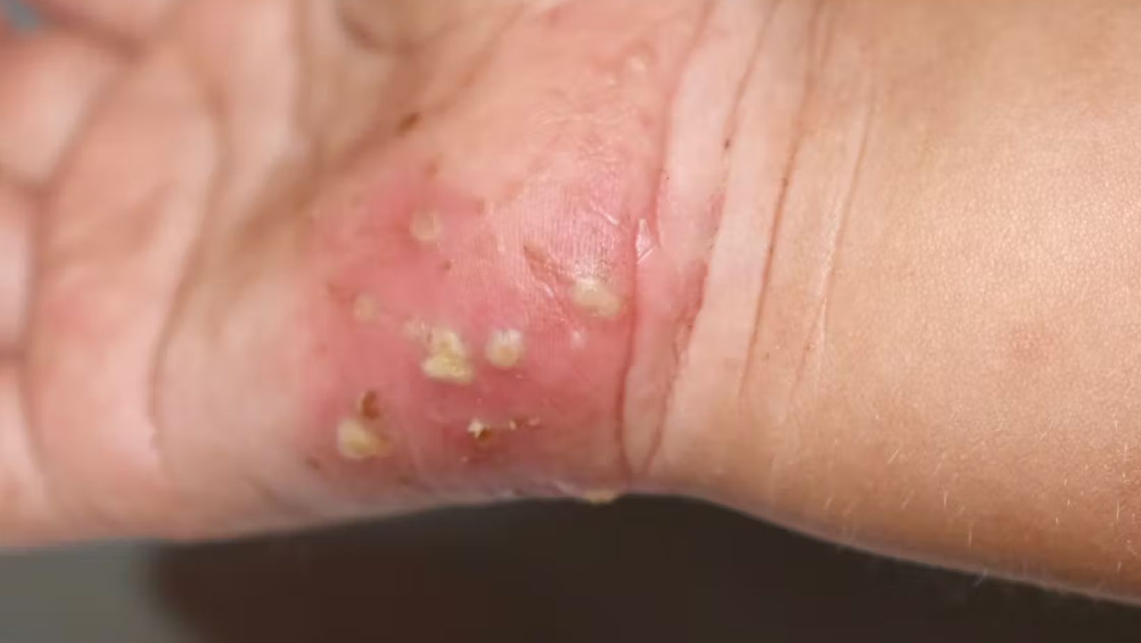 Spike in NSW Google Searches Amid Scabies Outbreak in Hospitals