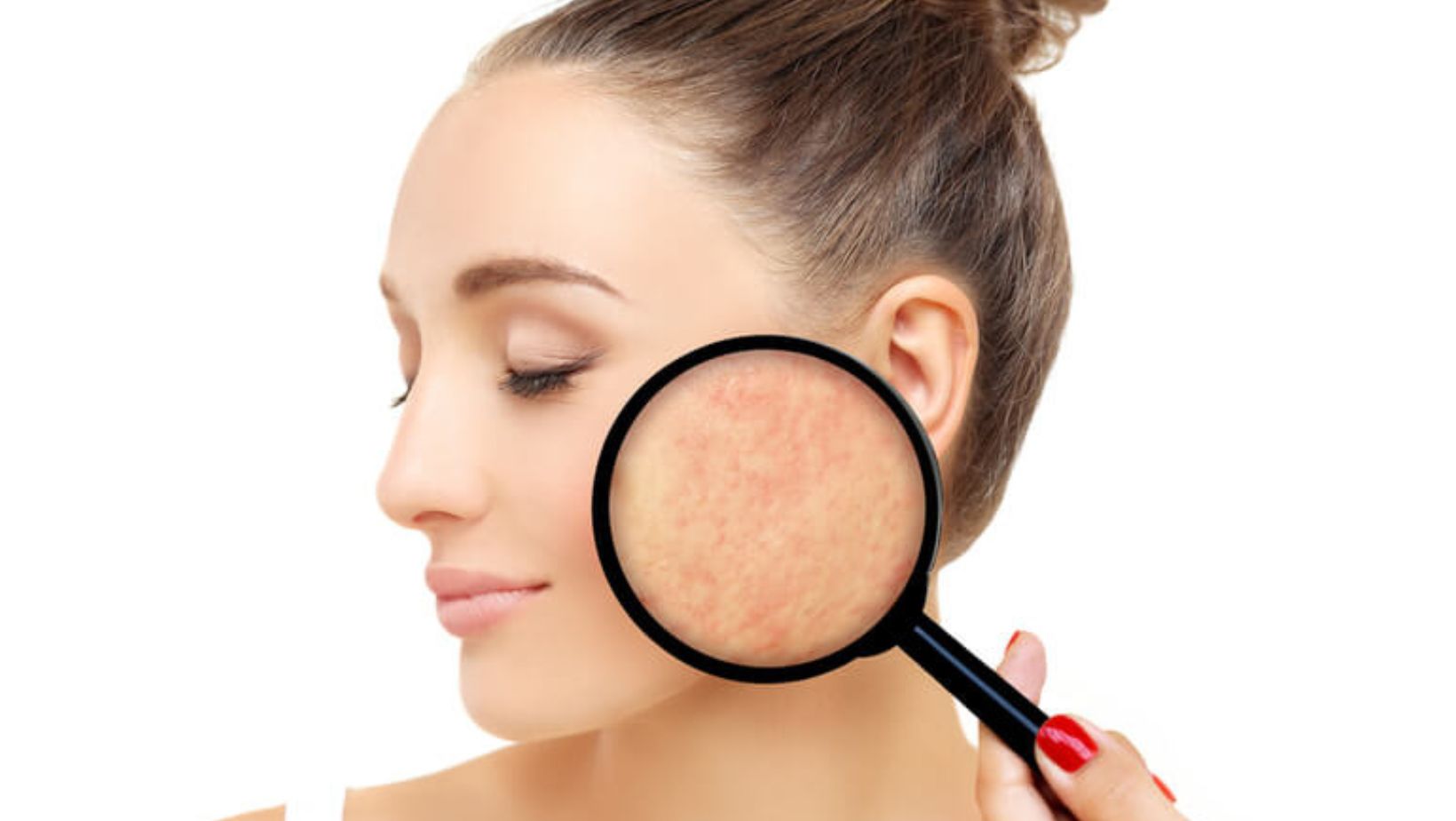 To Squeeze or Not to Squeeze? Why Popping Pimples Does More Harm Than Good